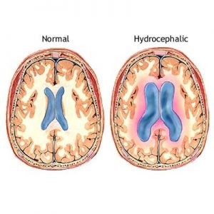 Υδροκέφαλος: Συχνά αδιάγνωστος και με παραπλανητικά συμπτώματα